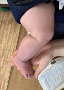 抱っこ紐で赤ちゃんの足がうっ血してしまったときの原因と対策方法は しいの育児ブログ